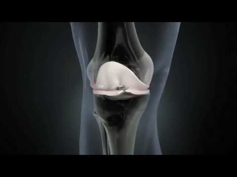Cum să tratezi o luxație a genunchiului