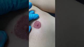 Male Nipple & Areola Cosmetic Tattoo Vitiligo Colour Restoration by El Truchan @ Perfect Definit