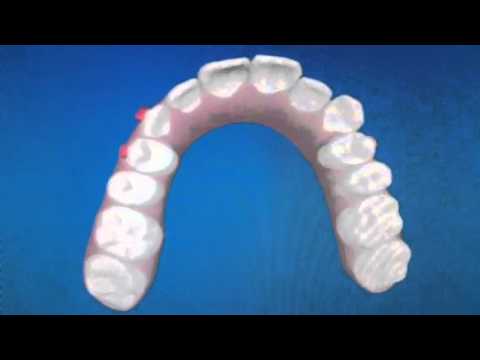 Invisalign Braces - Tracey Bell