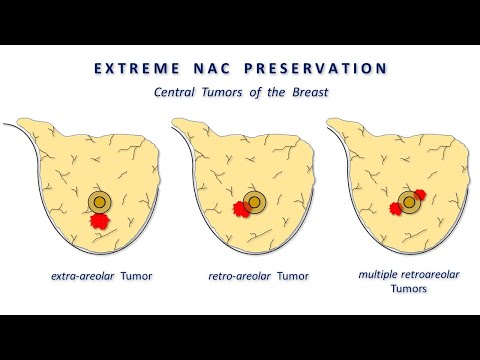 Extreme preservation of the Nipple-Areola Complex in Central Tumors of the Breast - Breast Surgeons Web