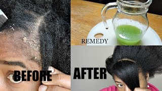HOME MADE REMEDY FOR DANDRUFF CURE || THIS WILL GET RID OF YOUR DANDRUFF