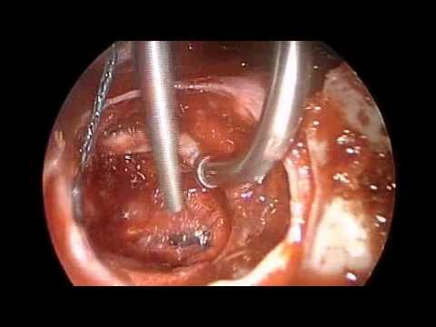 Endoscopic Removal of Pituitary Tumor Causing Hydrocephalus