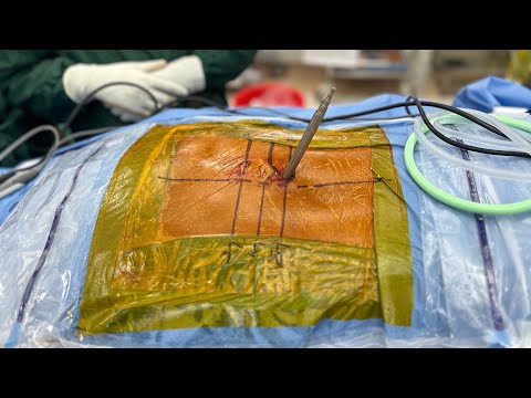 What is key hole spine surgery? | Dr. Ajay Kothari 