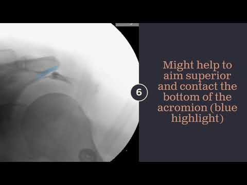 1 Minute Shoulder Subacromial Bursa Injection