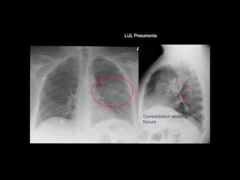 Chest X-ray: Cases 1