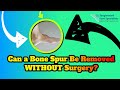 Can A Bone Spur On Feet Be Removed Without Surgery