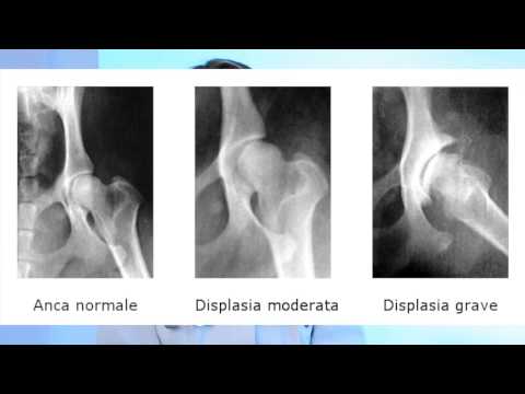 Fa lomeopatia da osteocondrosi Dolore alle articolazioni dopo lARI in un bambino