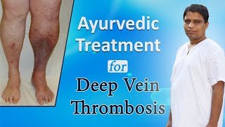 Ayurvedic Treatment for Deep Vein Thrombosis | Acharya Balkrishna