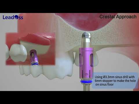 LeadOss | Sinus KIT for Crestal Approach