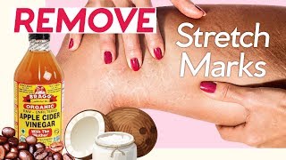 How to Get Rid of Stretch Marks! 7 Natural Ways + 4 Pressure Points