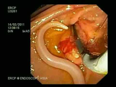 Lyambliya al bambino di 6 anni Dopo medicina per vomito di vermi