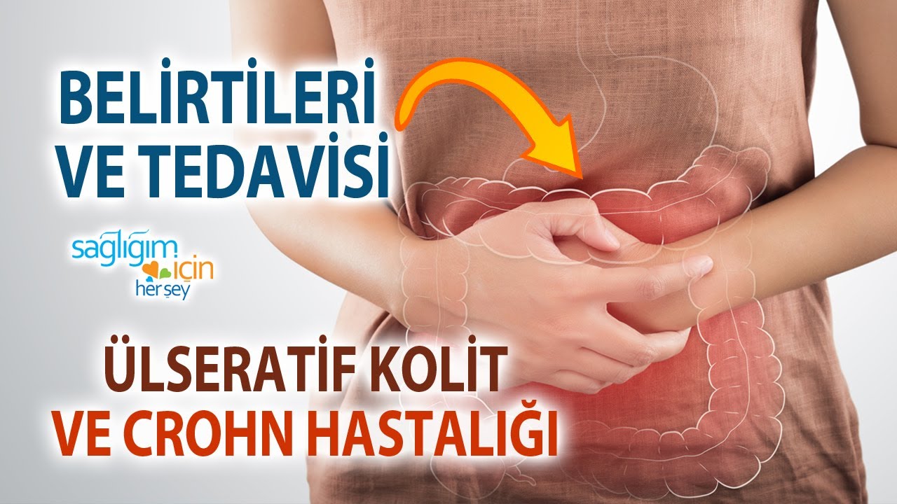 Ülseratif Kolitin ve Crohn Hastalığının Belirtileri ve Tedavisi