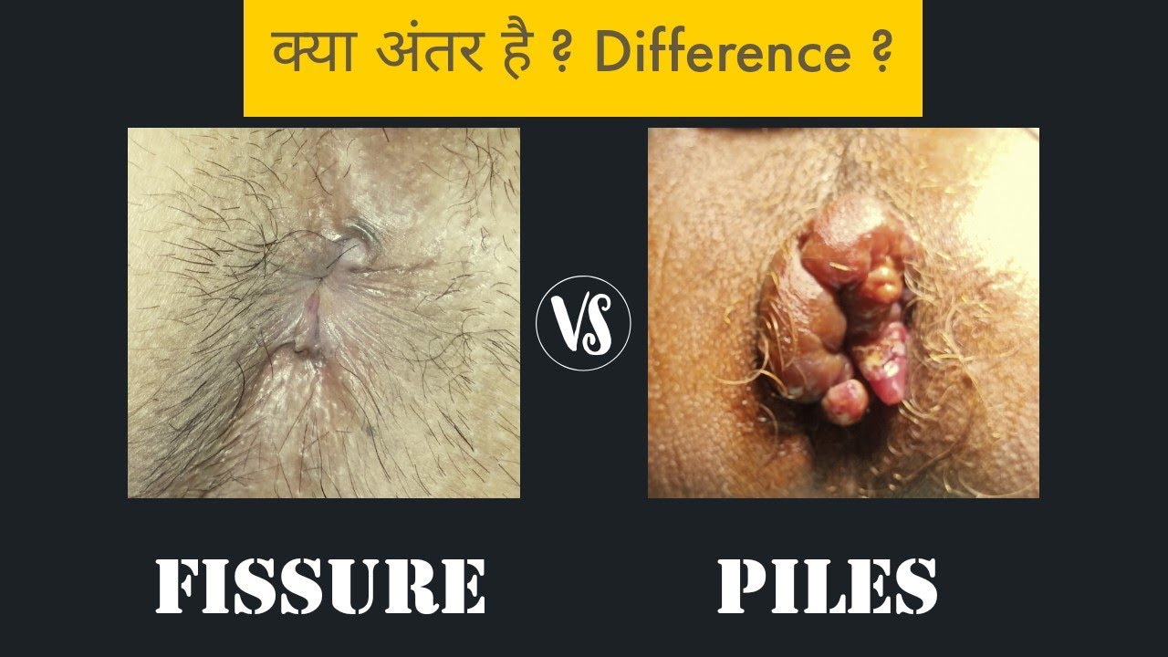 Piles vs Fissure - Difference 