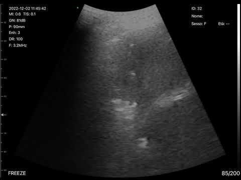 BEDSIDE ULTRASOUND WITH CERBERO ATL Wireless Probe - Acute Pneumonia with pleural effusion