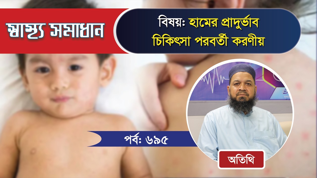 হামের প্রাদুর্ভাব: চিকিৎসা পরবর্তী করণীয়