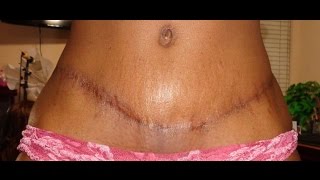 Tummy Tuck Surgery: My Journey from Beginning to End