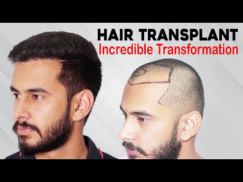 Best Hair Transplant in India Cost | Best Clinic |...