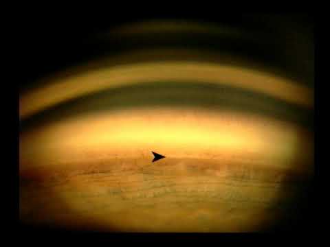 Gonioscopy - Normal Angle - 2