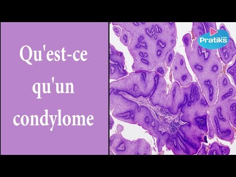 comment guerir condylome