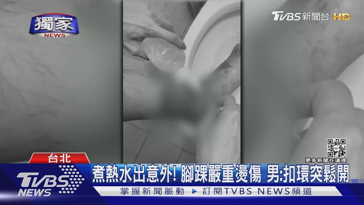 鍋把手鬆脫男2度燙傷! 山友怒:遲1年才召回