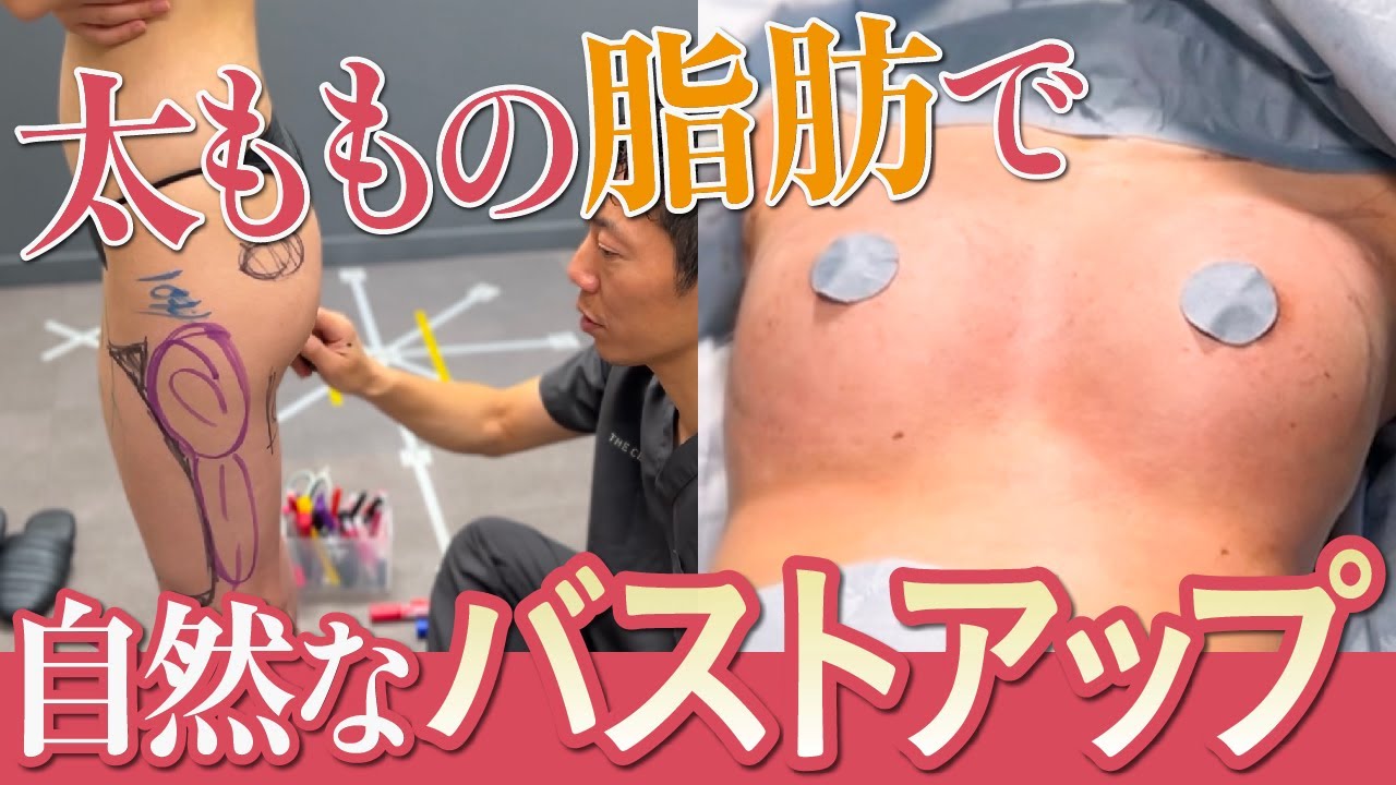 太ももの脂肪を活用した脂肪注入豊胸で自然にバストアップ!