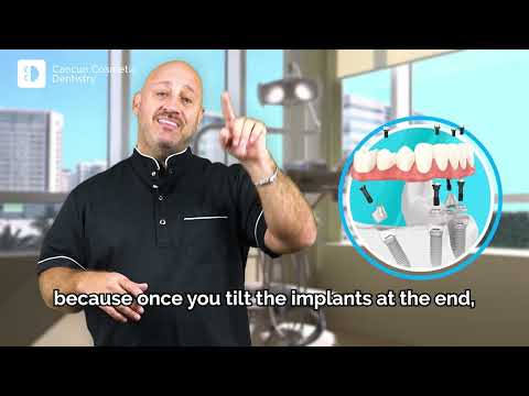 𝐀𝐥𝐥-𝐨𝐧-𝟒  vs 𝐀𝐥𝐥-𝐨𝐧-𝟲  Dental Implants: What You Need to Know | Choosing the Best Implant Solution