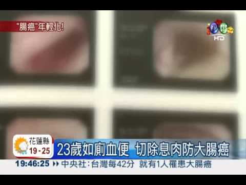 癌症不是老人病! 1/3可預防