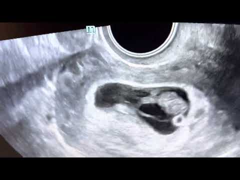 Take a Peek!  Ultrasound of a triple sac pregnancy at 8 weeks, continuing as twins!