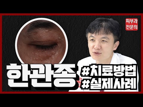 눈가에 오돌도톨;; 한관종 치료, Co2가 좋을까 아그네스가 좋을까? 한관종 치료 실제치료 결과 공개!