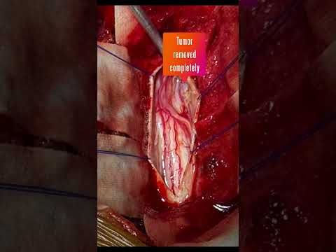 Intradural Spine Tumor 