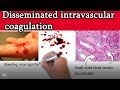 Disseminated intravascular coagulation (DIC) - Causes, Symptoms, Treatment and prognosis