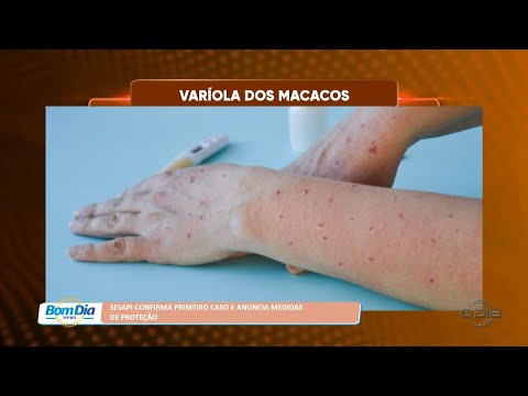 SESAPI confirma primeiro caso de Varíola dos Macacos e anuncia medidas de proteção 05 08 2022
