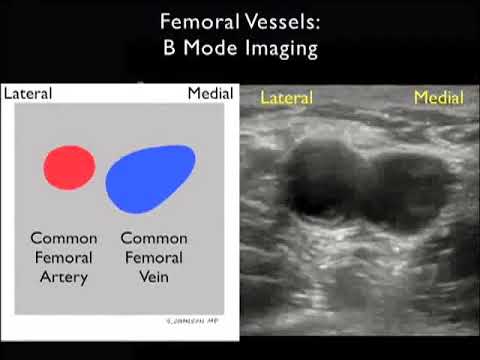 How to  Case Study Deep Vein Thrombosis Detection with Ultrasound Part 1