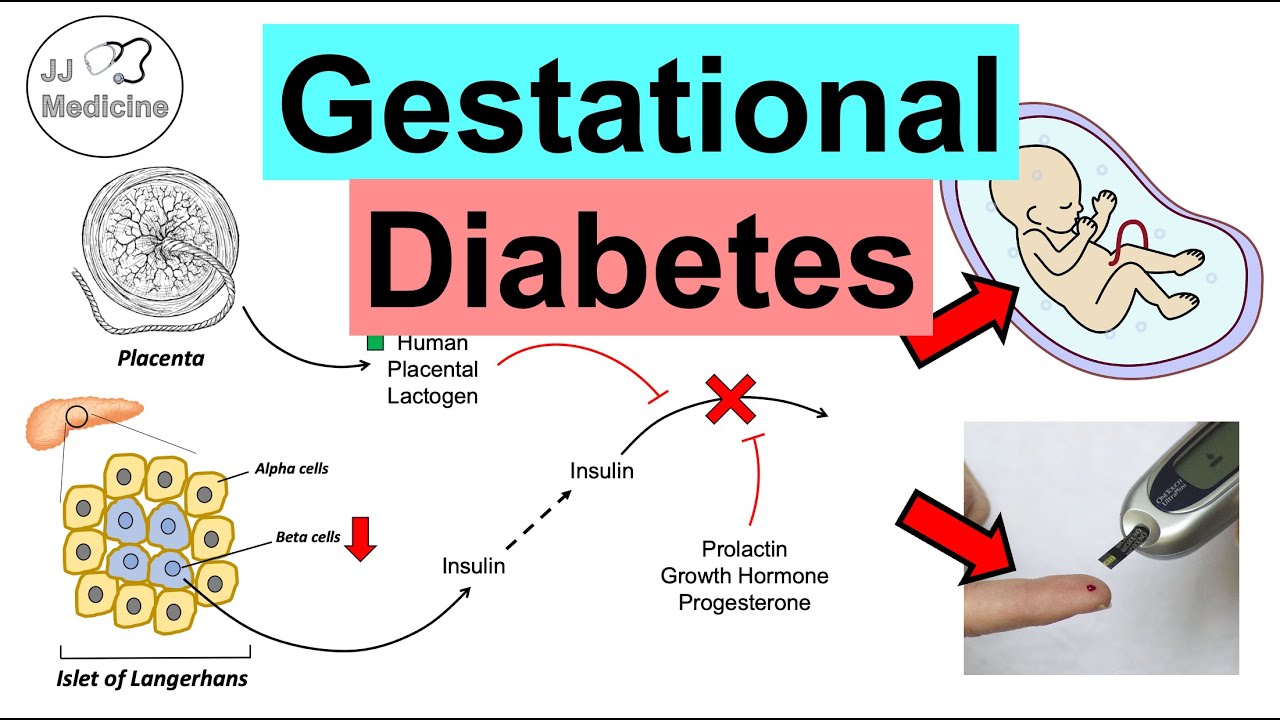 Gestational Diabetes (Pregnancy Diabetes) | Causes, Risk Factors, Symptoms, Consequences, Treatment