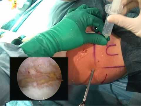 Mal di testa dopo lesercizio sulla schiena Trattamento delle spine della colonna vertebrale