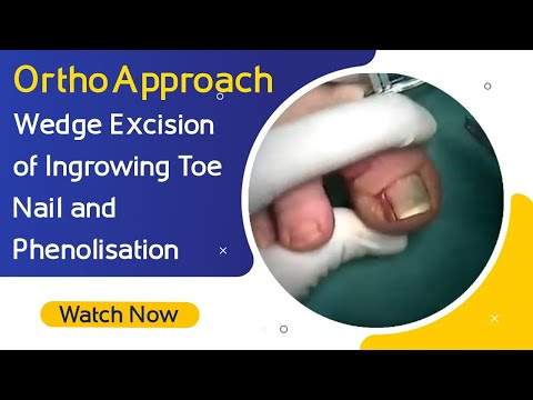 OrthoApproach - klinowe wycięcie wrastającego paznokcia i fenolizacja