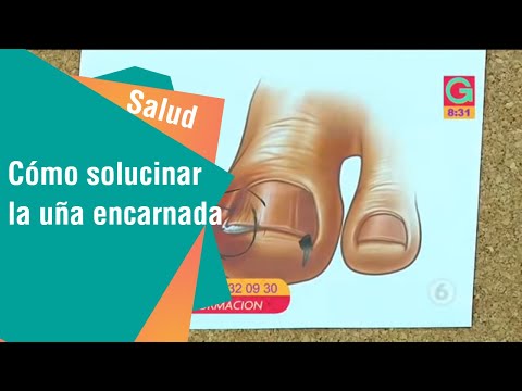 El hongo en el medio El tratamiento láser del hongo de las uñas en rostove en donu