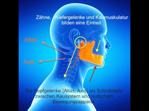 CMD und Instabilität obere HWS