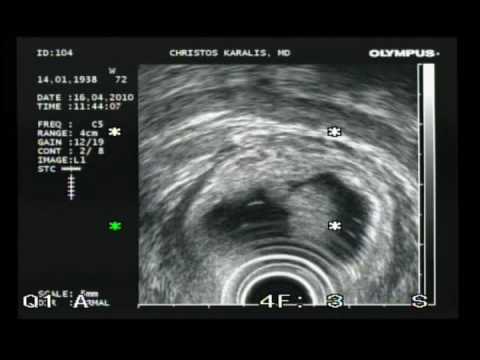 Excision Of Polyp In Rectum