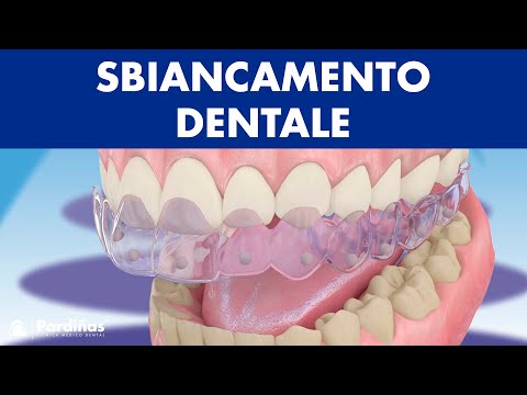 Sbiancamento dentale ©