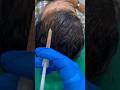 बालों का झड़ना , गंजा होना , बालों का पतला होना #hair #prp #hairtransplant #ytshorts #shorts #viral