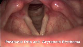 Hoarseness with Postnasal Drip and Acid Reflux