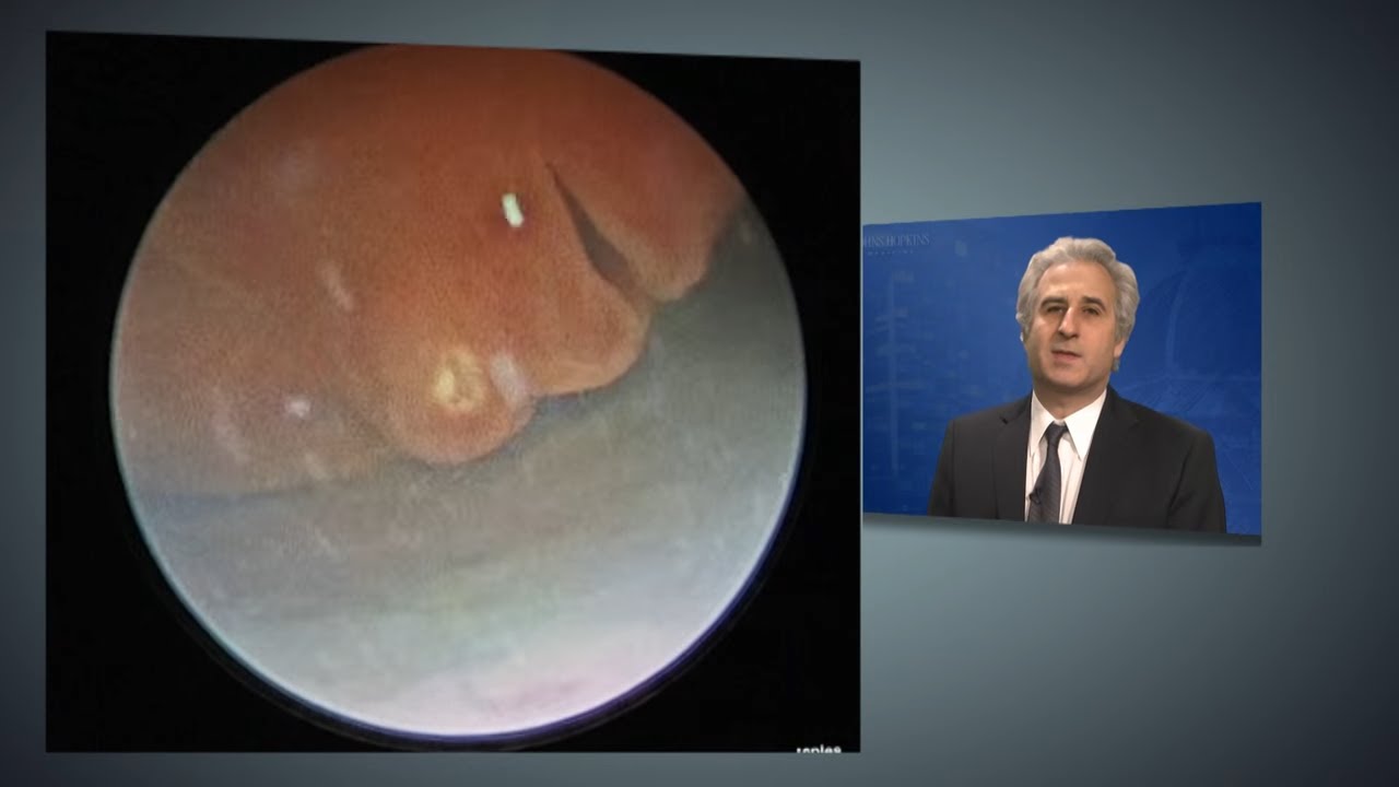 What is laser ablation for TTTS? Tipseri