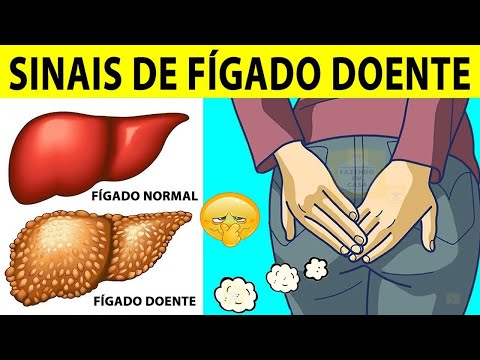 , title : '10 Sinais de FÍGADO Doente'