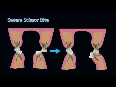 Correcting severe scissor bite in an adult