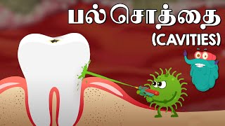 பல் சொத்தை  What Causes Cavities