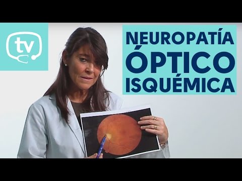 ¿Qué es la neuropatía óptico isquémica?