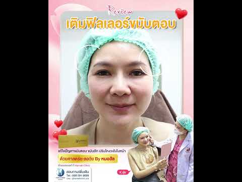 รีวิวหัตถการโปรแกรมฟิลเลอร์ขมับตอบ