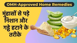 OMH-Approved Home Remedies To Erase Acne Scars