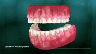 Understanding Tooth Wear